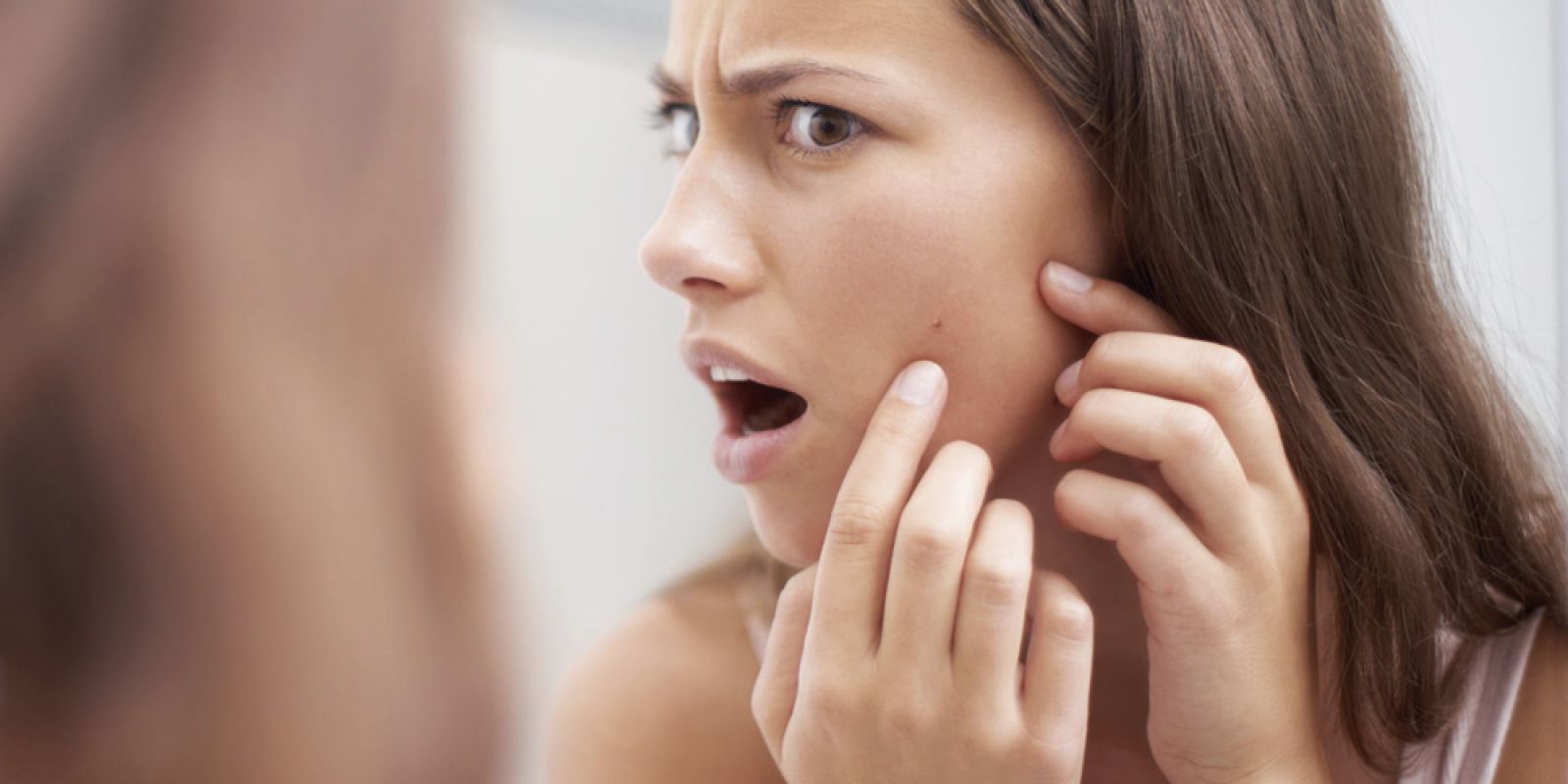 De ce tot mai multi adulti dezvolta acnee?