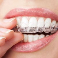 Cine poate apela la albirea dentara? 